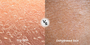 The Difference Between Dry And Dehydrated Skin