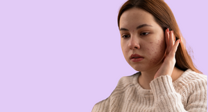 How To Get Rid Of Hormonal Acne Naturally