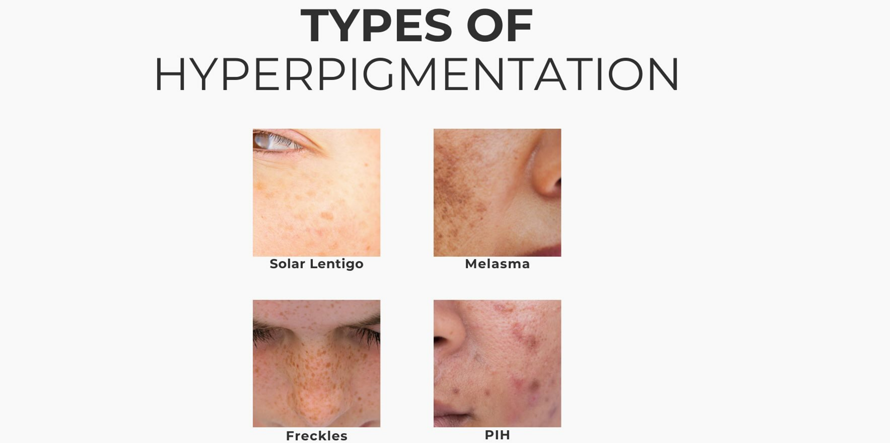 Hyperimpigmentation Skin Functional Different Types of Hyperpigmentation: Causes & Treatment