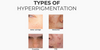 What Are the Different Types of Hyperpigmentation?